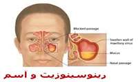 وبینار "برخورد با بیمار مبتلا به رینوسینوزیت و آسم" برگزار می شود